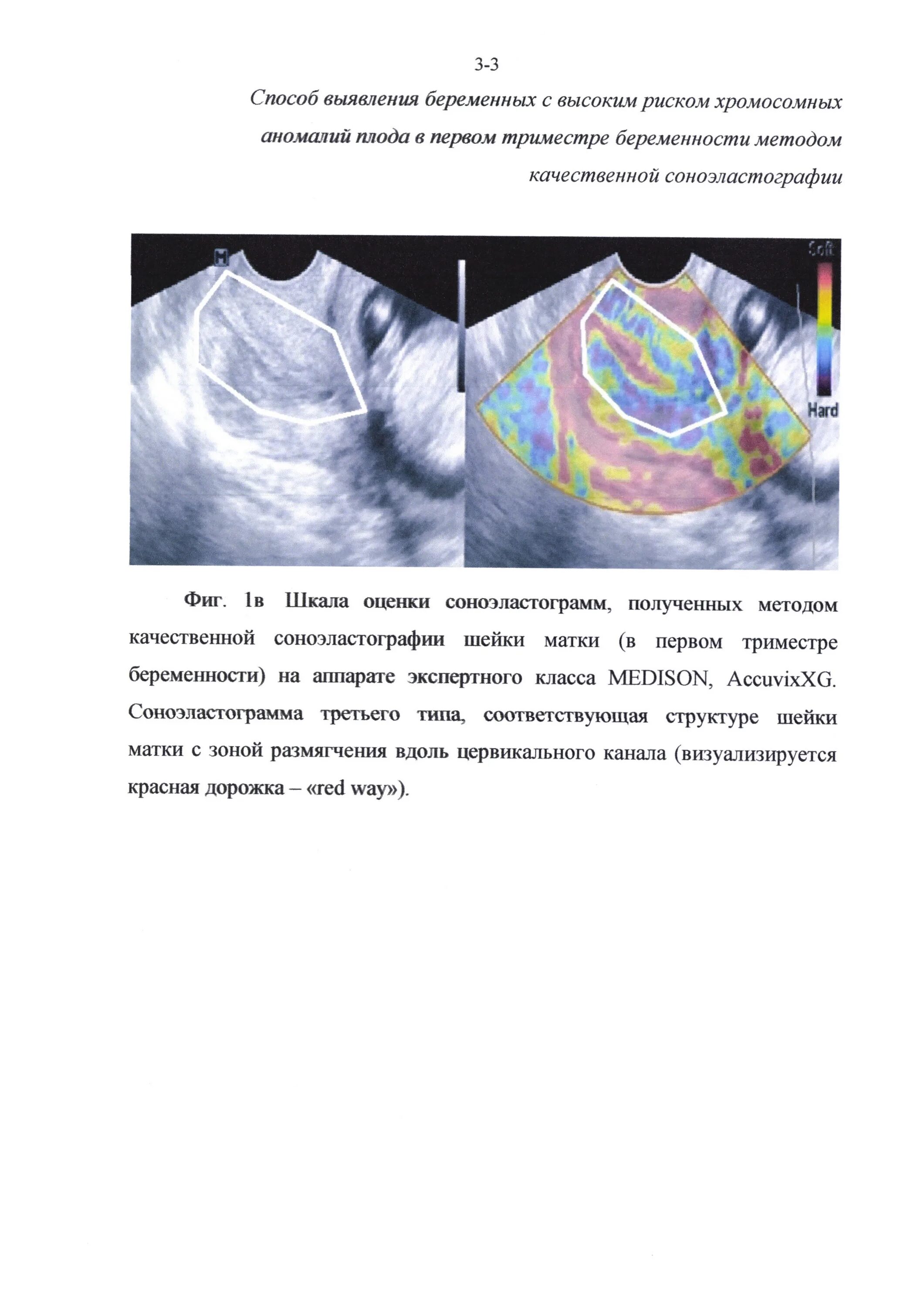 Инвазивная диагностика хромосомных аномалий. Соноэластография. Соноэластография мягких тканей. Ultrasound diagnosis of pregnancy. Инвазивный тест при беременности
