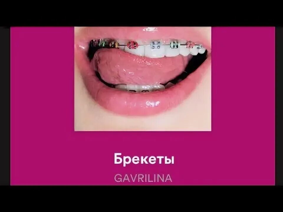 Аня енина блоггер. Кэти перри клип с брекетами. Кэти перри в брикетах. Юля гаврилина брекеты песня. Девочка с косичками и брекетами.