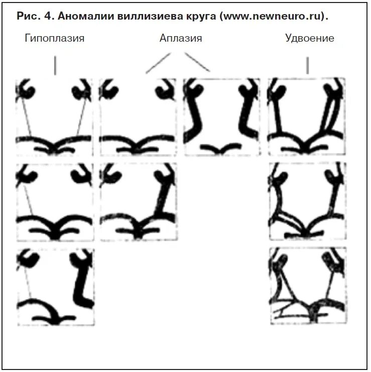 Виллизиев круг вариант развития на мрт. Варианты развития передней мозговой артерии. Варианты строения Виллизиева круга мрт. Варианты развития Виллизиева круга на мрт. Варианты анатомии Виллизиева круга.
