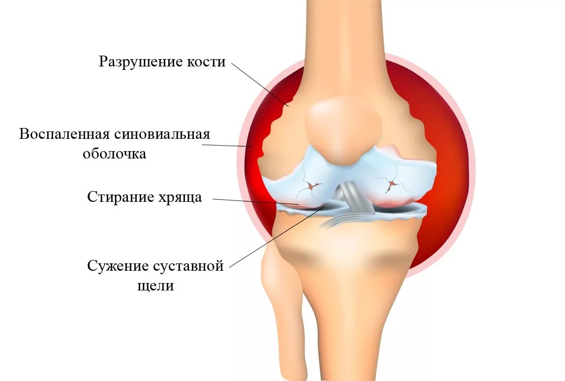 Ювенильный ревматоидный артрит суставная форма. Системный ювенильный ревматоидный артрит. Ювенильный ревматоидный артрит коленного сустава. Ревматоидный артрит коленного сустава у ребенка. Артралгия у детей