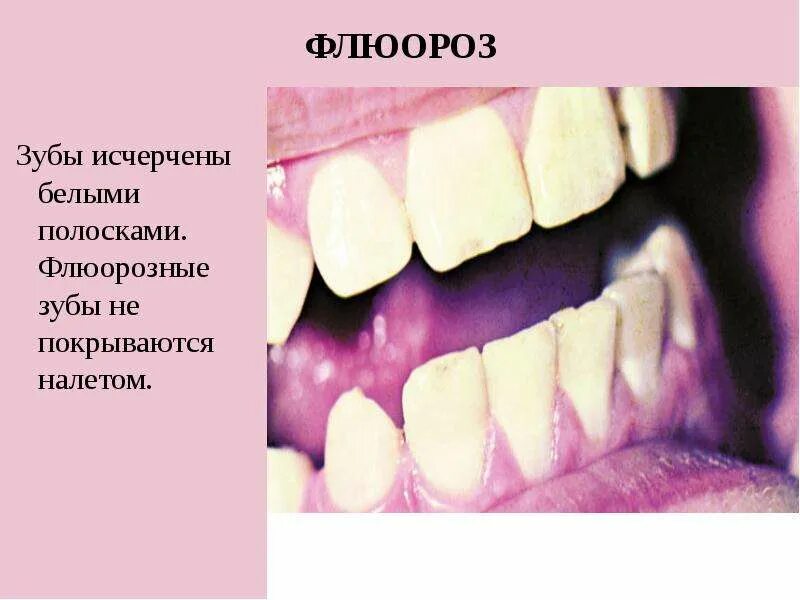Классификация флюороза. Меловидно крапчатый флюороз. деструкционный флюороз. клинические проявления флюороза. пятнистая форма флюороза.