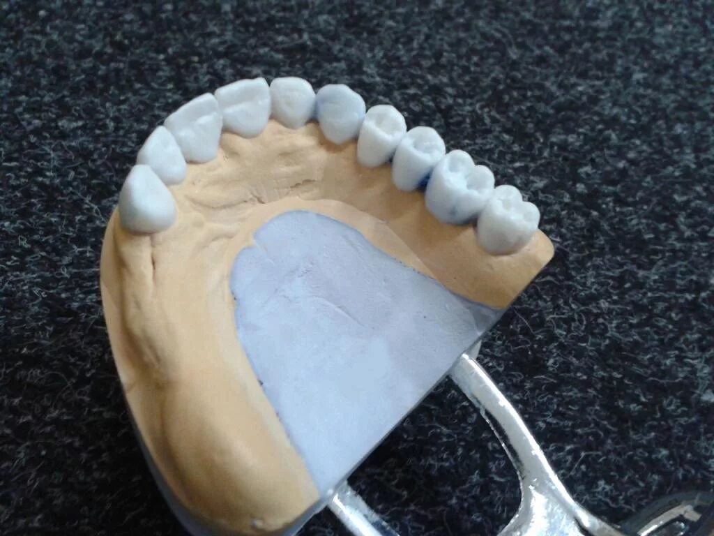 Моделирование зубных протезов. Протезы на 3 д принтере стомат. Моделировка базиса нижней челюсти. Моделировка съемного протеза верхней челюсти. Моделирование съемного протеза.