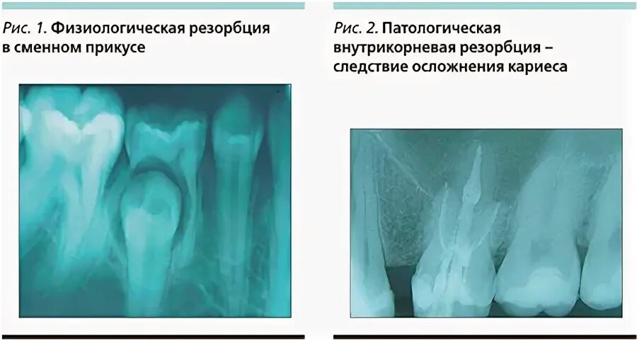 Наружная апикальная резорбция корня. Резорбция костной ткани зуба рентген.