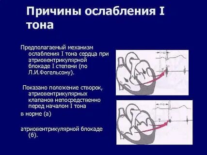 Тоны клапанов