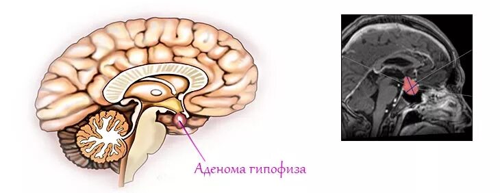 Соматотропная аденома гипофиза. Опухоль микроаденома гипофиза. Эндоселлярная аденома гипофиза головного мозга. Интраселлярной аденомы гипофиза.