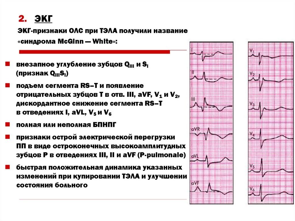 Тромбоэмболия легочной артерии экг. ЭКГ при тромбоэмболии легочной. Признаки Тэла на ЭКГ. На ЭКГ признаком тромбоэмболии легочной артерии является. Изменения ЭКГ при эмболии легочной артерии.