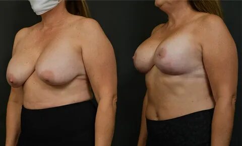 by removing the excess inferior and lateral droopy breast tissue and placin...