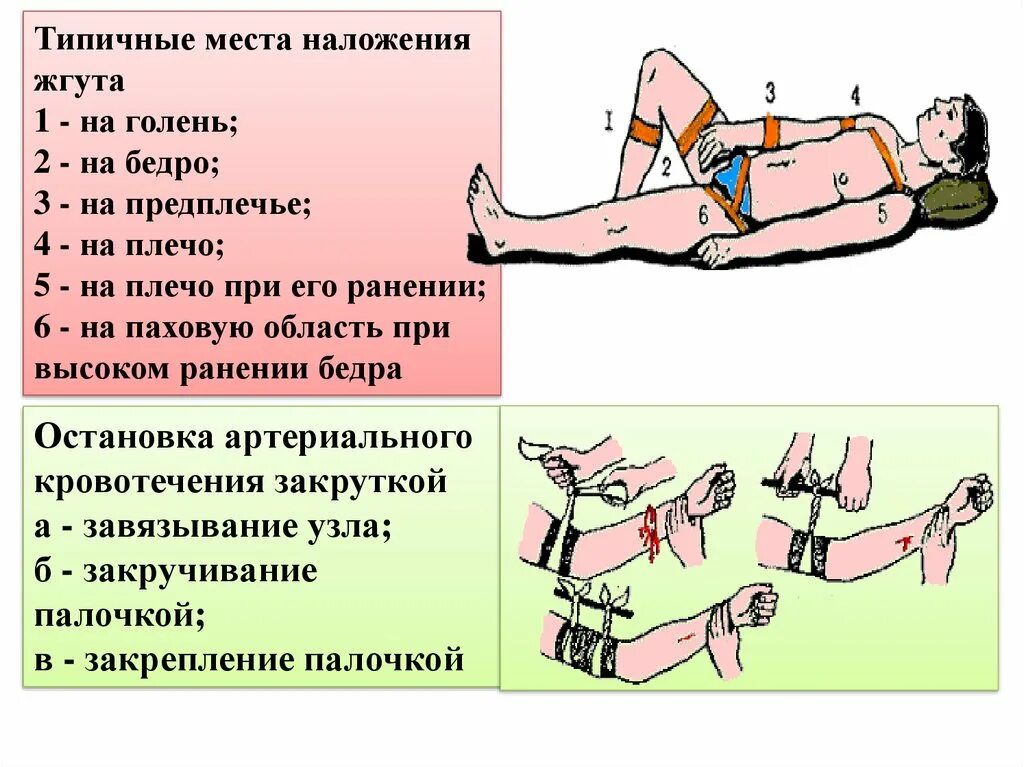 Признаки неправильного наложения жгута. Техника наложения жгута при артериальном кровотечении. Техника наложения жгута на конечности при артериальном кровотечении. Наложение кровоостанавливающего жгута при кровотечении. Типичные места наложения жгута.