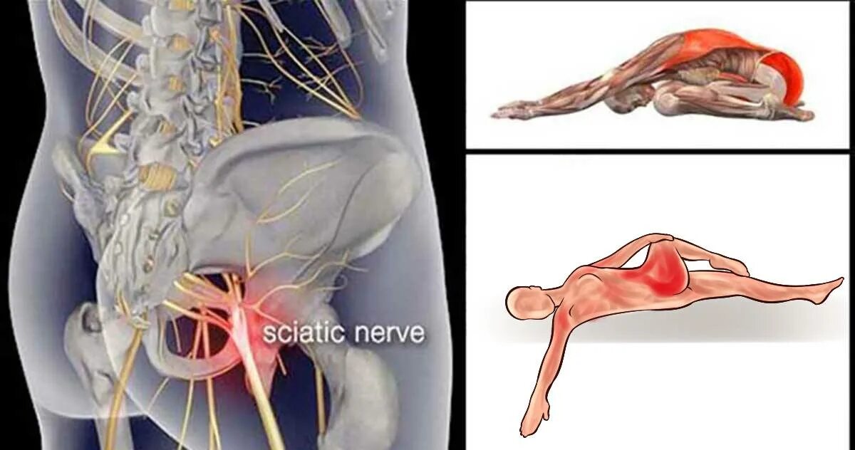 Можно париться при защемлении. Ишиас воспаление седалищного нерва. Воспаление воспаление седалищного нерва. Сидалеч седалищный нерв. Ишиас воспаление седалищного.
