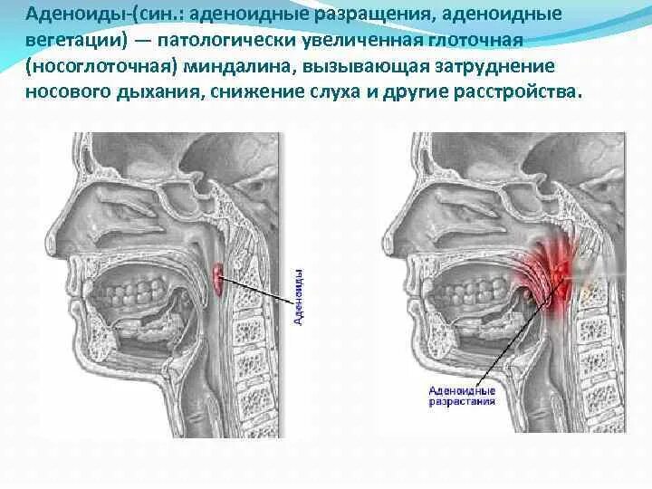 Аденоидные вегетации 1. Аденоиды рентгенограмма носоглотки. Носоглотка воспаление аденоиды. Гиперплазия миндалин носоглотки.