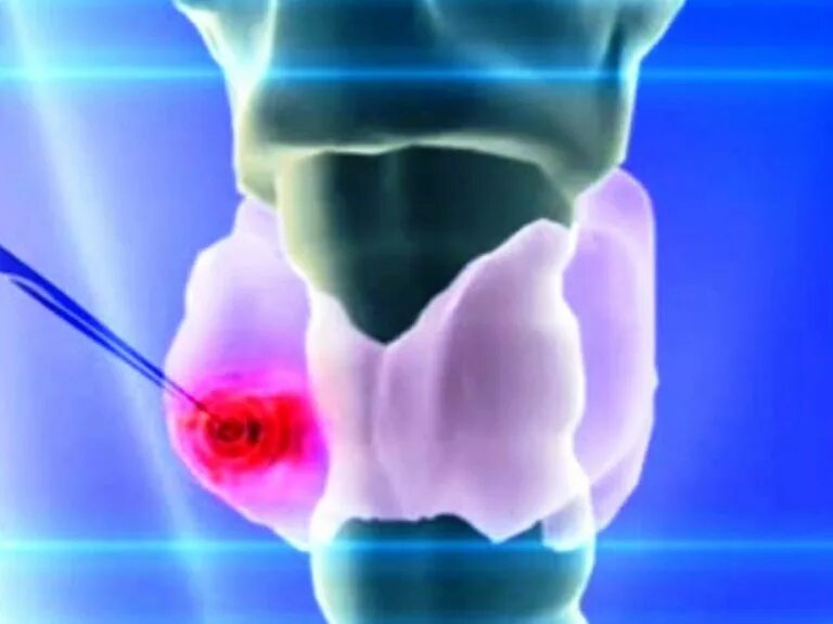 узи критерии аденомы паращитовидной железы. токсическая аденома щитовидной (пламмера) железы. аденома паращитовидной железы на узи. гиперпаратиреоз аденома щитовидной железы. липоаденома пращитовидной железы.