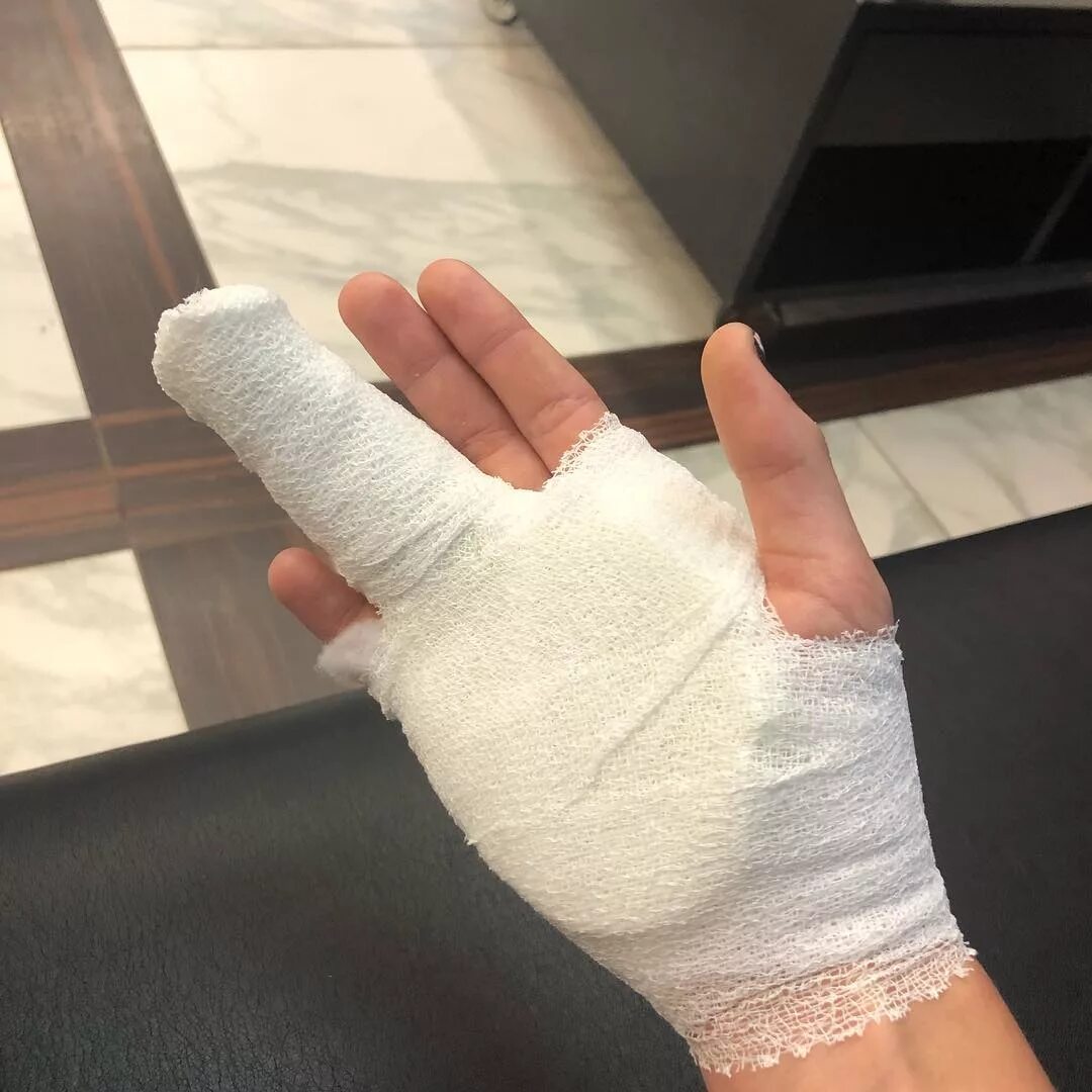 сломанный палец на ноге в гипсе. перелом большого пальца на ноге гипс. перелом пальца какой гипс. гипс при переломе ладьевидной кости. гпс при пеломе мезинца ноги.