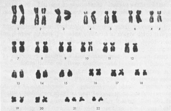 Пересадка хромосом. Кариограмма синдрома Дауна. Кариограмма синдрома Эдвардса. Кариотип млекопитающих. Кариотип человека с синдромом Дауна.