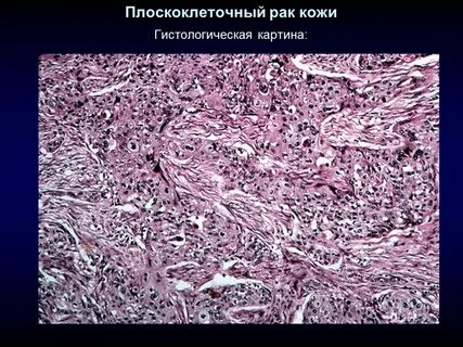 Карцинома отзывы
