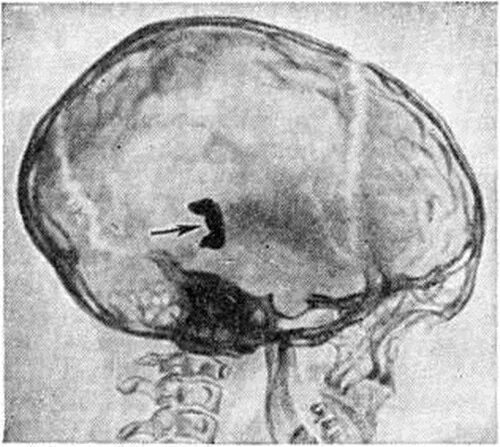 Диета при гидроцефалии мозга. Гидроцефалия на рентгенограмме. Гидроцефалия период декомпенсации. Гидроцефалия неоперабельная.