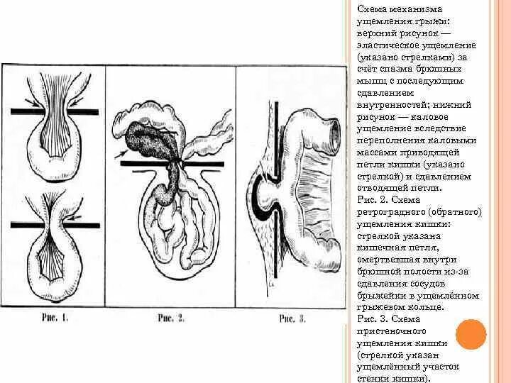 Ответы ущемленная грыжа. Механизм калового ущемления грыжи. Эластическое ущемление грыжи механизм. Ущемленные грыжи механизмы ущемления.