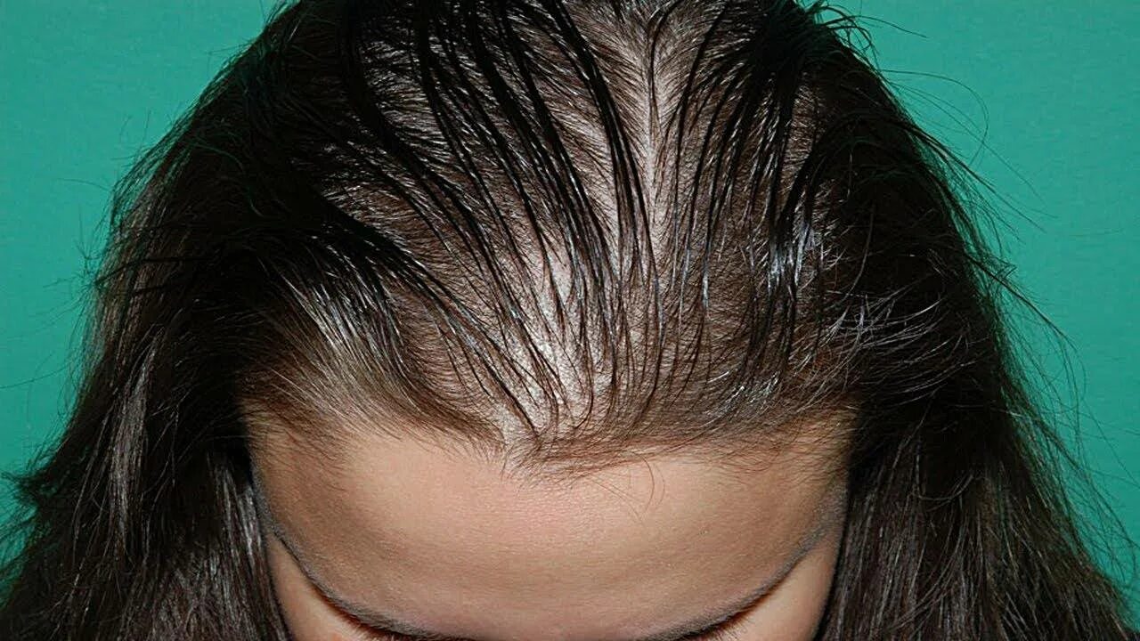 Как остановить выпадение волос после. Андрогензависимая алопеция. Андрогенная алопеция алопеция. Гиперандрогенная алопеция.
