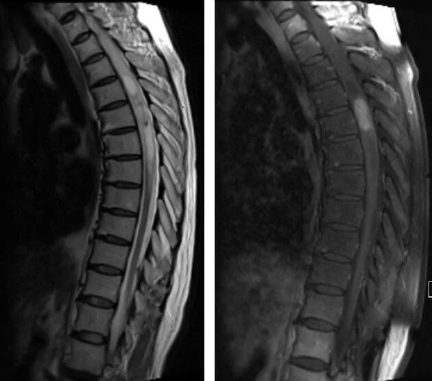 Эпендимома спинного. Сирингомиелия грудного отдела мрт позвоночника. Мрт грудного отдела позвоночника норма. Эпендимома мрт позвоночника. Сирингомиелия снимок мрт.
