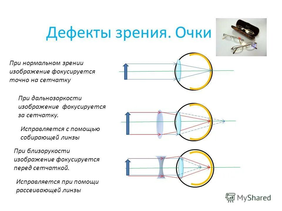 Как понять минус зрения. Дефекты зрения дальнозоркость и близорукость и их коррекция. форма линзы при близорукости и дальнозоркости. тип линзы при близорукости. близорукость и дальнозоркость в оптике.