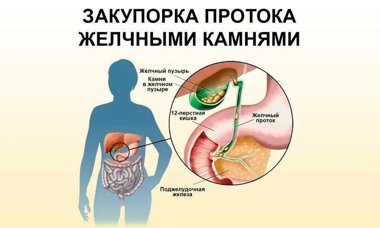 Камни в протоке печени. Закупорка камнем желчного протока. Закупорка желчных протоков. Закупорка желчевыводящих протоков. Закупорка протоков желчи.