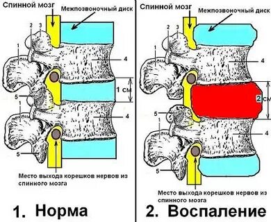 Грыжа степени