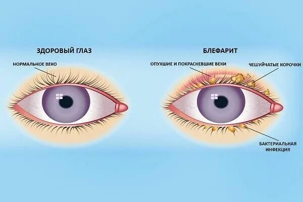 Демодекоз век блефарит век. Глазная болезнь блефарит. Блефарит блефароконъюнктивит. Демодекозный блефарит демодекозный. Ресничный край века