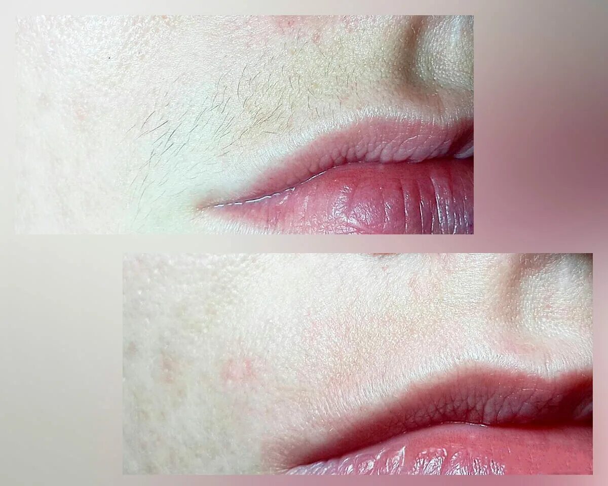 Шугаринг губа. Лазерная эпиляция верхней губы. Лазерная эпиляция волос над верхней губой. Лазерная эпиляция верхней губы до и после.