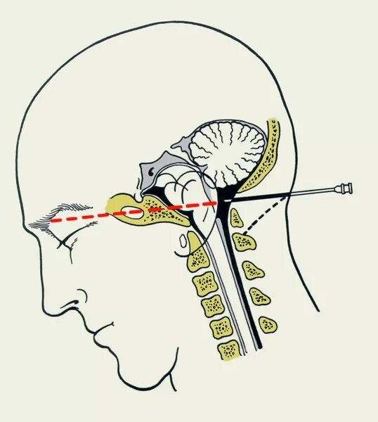 Как делают пункцию мозга. Субокципитальная пункция. Субокципитальная пункция желудочков мозга. Цистериальная пункция. Пункция вентрикулярная люмбальная субокципитальная.