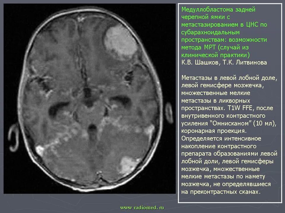 Медуллобластома это. Медуллобластома это
