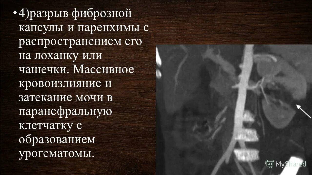 Зрелый разрыв. Разрыв фиброзной капсулы. Кровоизлияние в паранефральную клетчатку.