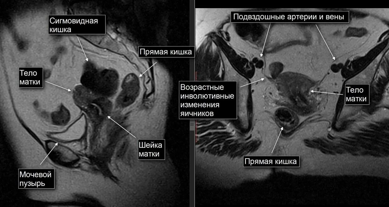 Кт малого таза с контрастом у мужчин. Кт анатомия малого таза у женщин. Мрт органов малого таза у женщин. Мрт анатомия малого таза женщины. Малый таз мрт анатомия.