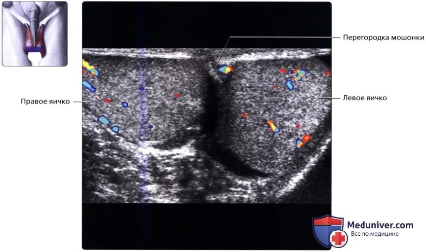 Норма.УЗИ мошонки.яичек. УЗИ органов мошонки + допплерография. УЗИ мошонки с допплерометрией. Нормальная яичка мужчин