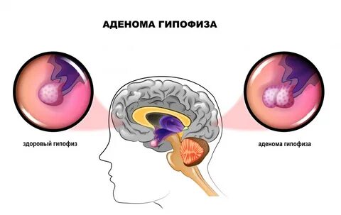 Киста аденомы гипофиза