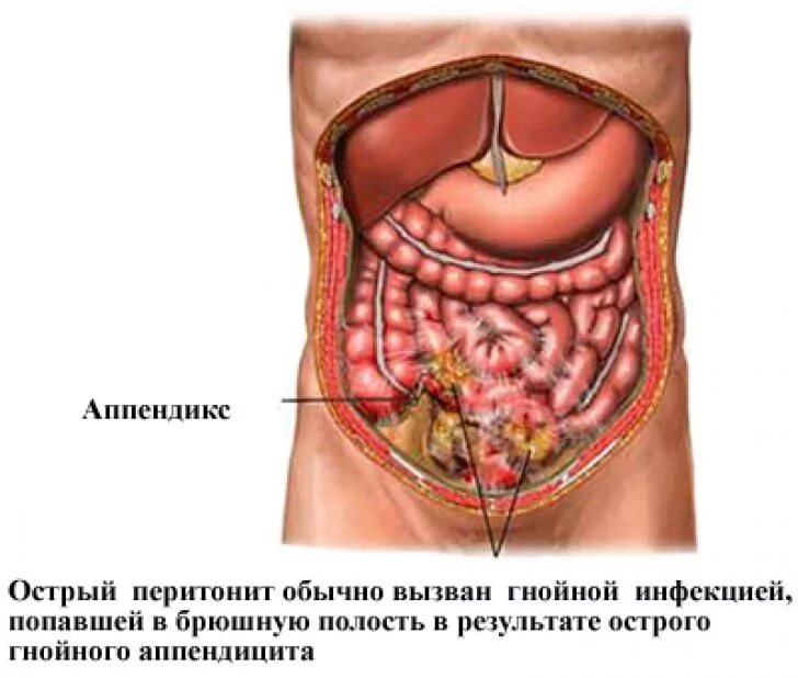 Острый аппендицит спеританитом. Органы брюшной полости лечение