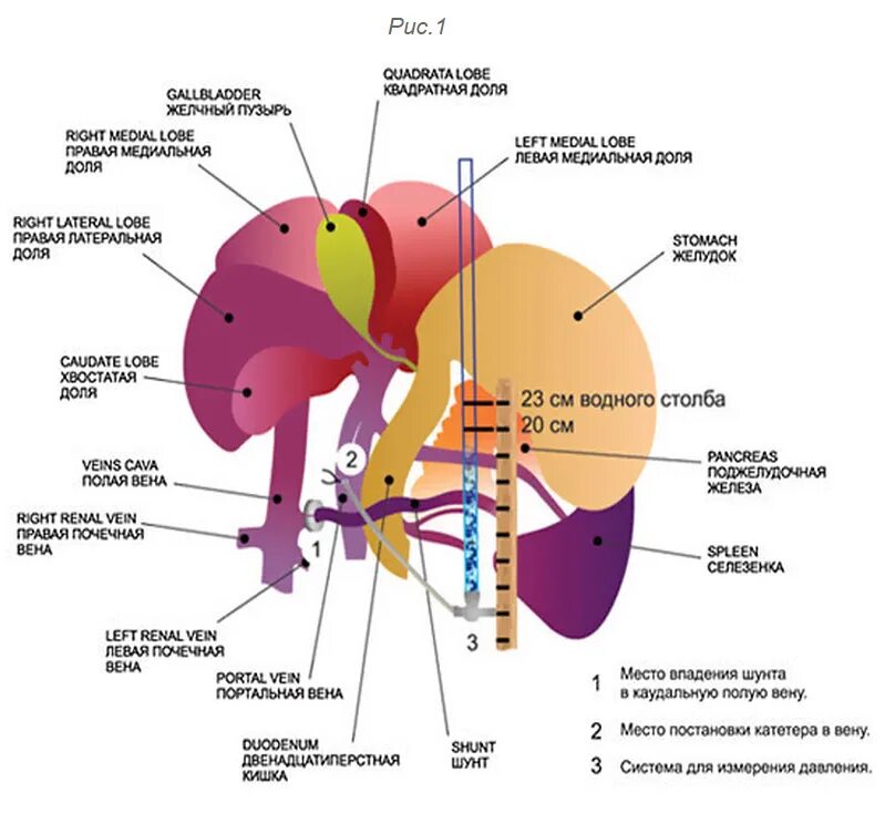 Портокавальный печёночный шунт. Печень портокавальный шунт. Спленоренальный шунт у собак. Портосистемный шунт у собак.