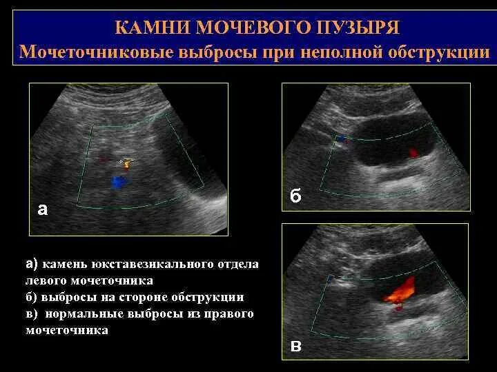 Конкременты мочевого пузыря на УЗИ. УЗИ мочевого пузыря поперечный срез. Стенки мочевого пузыря на УЗИ. Ультразвуковая диагностика мочевого пузыря.