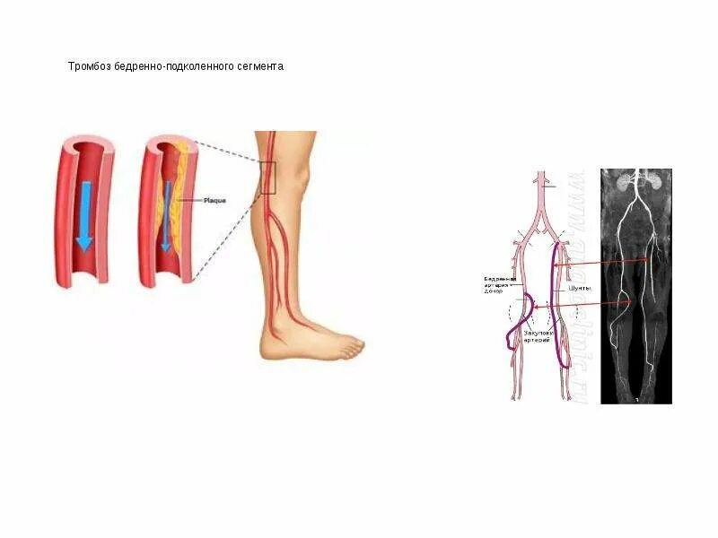 Клиника эмболии подколенной артерии. Тромбоз малоберцовой артерии. Артериальный тромбоз сосудов нижних конечностей. Тромбоз и эмболия сосудов нижней конечности. Тромбоз артерий лечение
