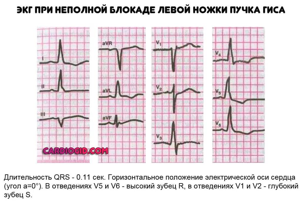 Блокада ножки гиса симптомы. ЭКГ при полной блокаде ножек пучка Гиса. Блокада правой ветви пучка Гиса на ЭКГ. Блокада ножек пучка Гиса ЭКГ критерии. Блокада передней ветви левой ножки пучка Гиса на ЭКГ.