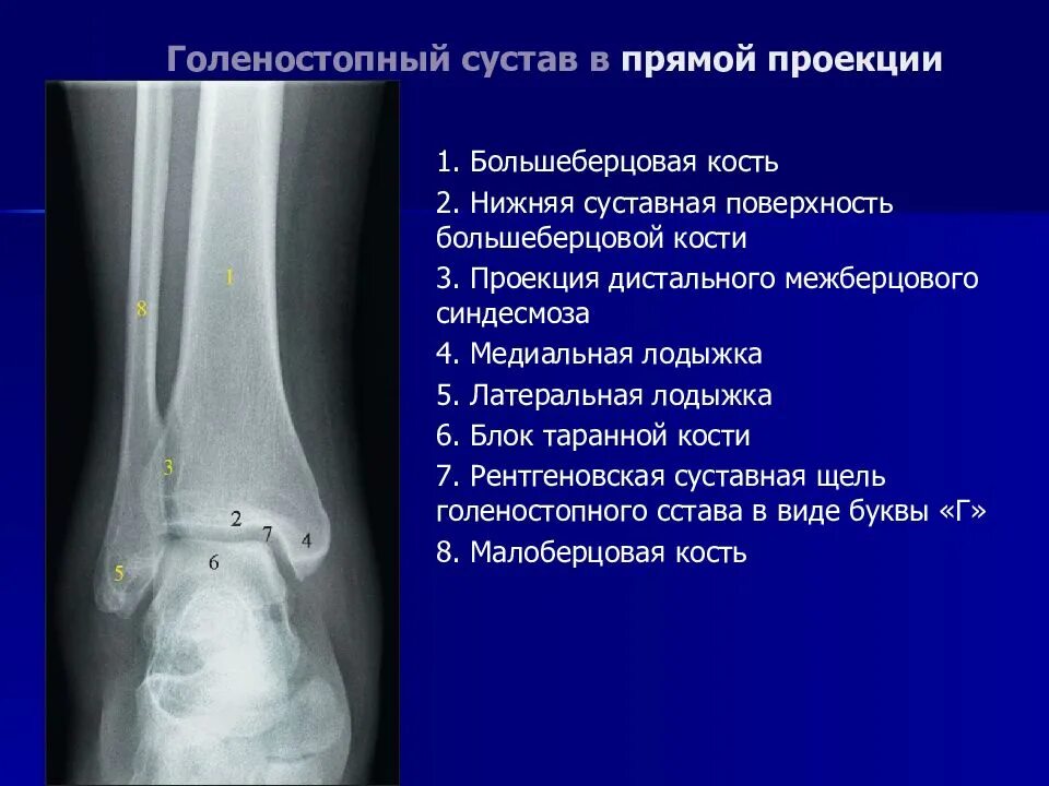 Разрыв дистального межберцового синдесмоза. Разрыв дистального межберцового синдесмоза рентген признаки. Межберцового синдесмоза голеностопного сустава. Межберцовый синдесмоз рентген норма.