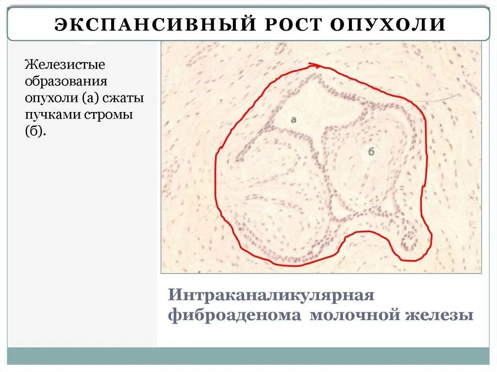 Экспансивный рост опухоли. Экспансивный и инфильтративный рост опухоли. Типы роста опухолей. Экспансивный рост это