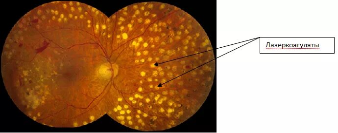 Диабетическая ретинопатия лазерная коагуляция. Периферическая профилактическая лазеркоагуляция сетчатки. Лазеркоагуляция сетчатки при диабетической ретинопатии. Глазное дно отслоение сетчатки.