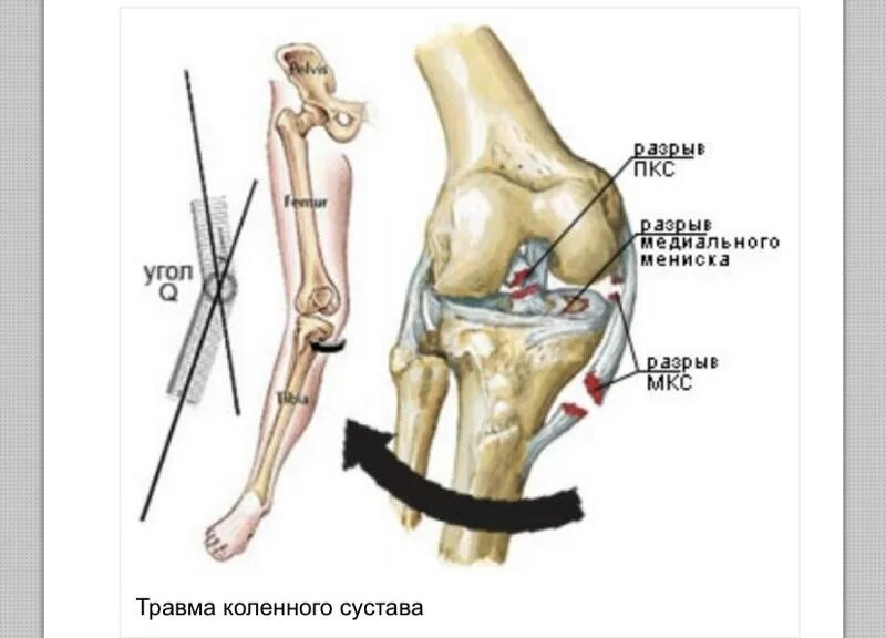 Разрыв передней крестовой связки коленного сустава. Травмы боковых связок коленного сустава. Механизм травмы при разрыве боковых связок коленного сустава. Повреждение внутренней боковой связки коленного сустава. Форум операции по замене суставов