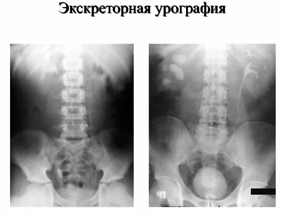 После урографии
