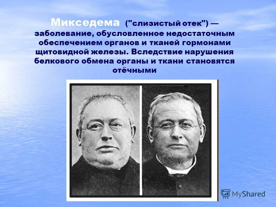 Микседема что за болезнь. Микседема (слизистый отёк) развивается вследствие:. Микседема - заболевание, обусловленное. Болезни щитовидной железы микседема.