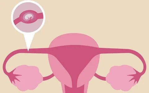 Ectopic Pregnancy Mumsnet