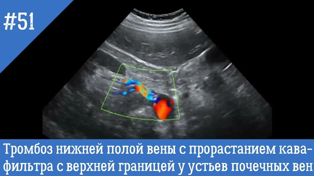 УЗИ кава фильтра нижней полой вены. Тромбоз нижней полой вены на УЗИ. Тромбоз почечных вен