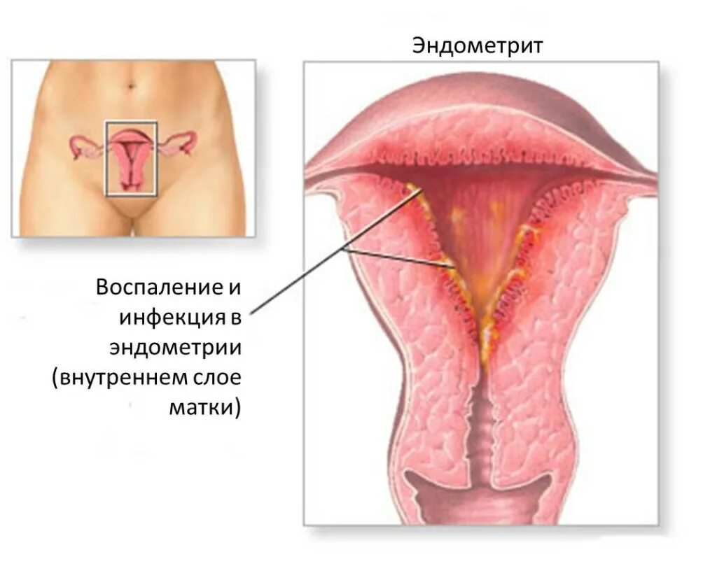 Эндометрии в полости. Воспаления внутренней оболочки матки. Послеродовой эндометрит. Герпетический эндометрит. Эндометрит это воспаление.