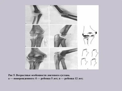 Повреждения суставов у детей