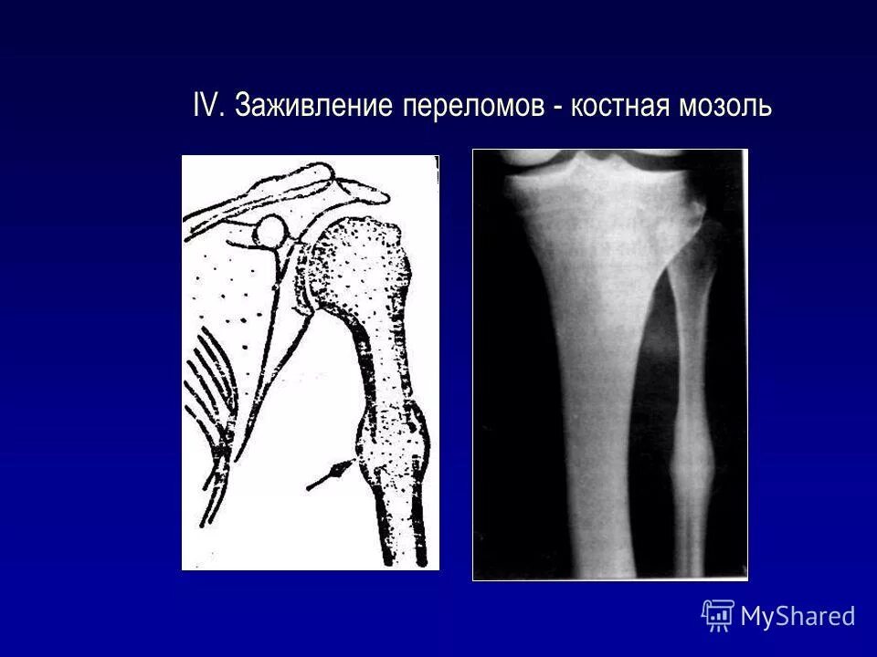 Трещина заживает