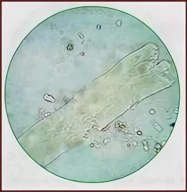 Повышенные цилиндры в моче. Гиалиновый цилиндр в моче микроскопия. Гиалиновые цилиндры микроскопия. Восковидный цилиндр в моче микроскопия. Цилиндры в моче микроскопия.